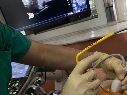 El Hospital La Candelaria aplica una técnica novedosa de crioablación en doce pacientes con cáncer de mama