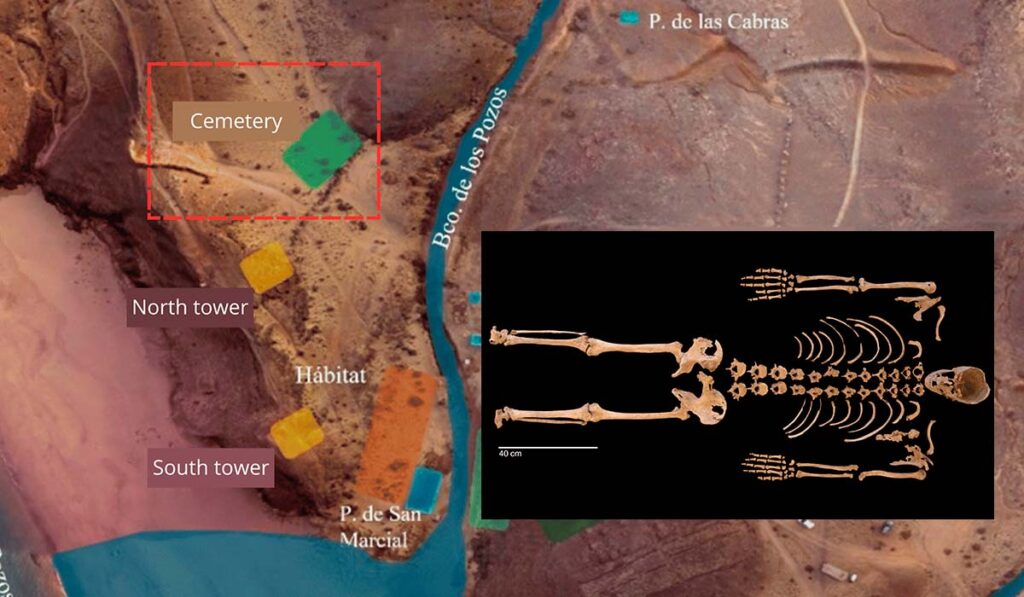 600 años bajo tierra: el esqueleto de Lanzarote que reescribe la historia de la enfermedad de Paget